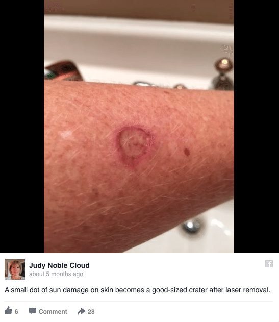 woman-shares-the-dangers-of-using-a-tanning-bed-without-sunscreen-with