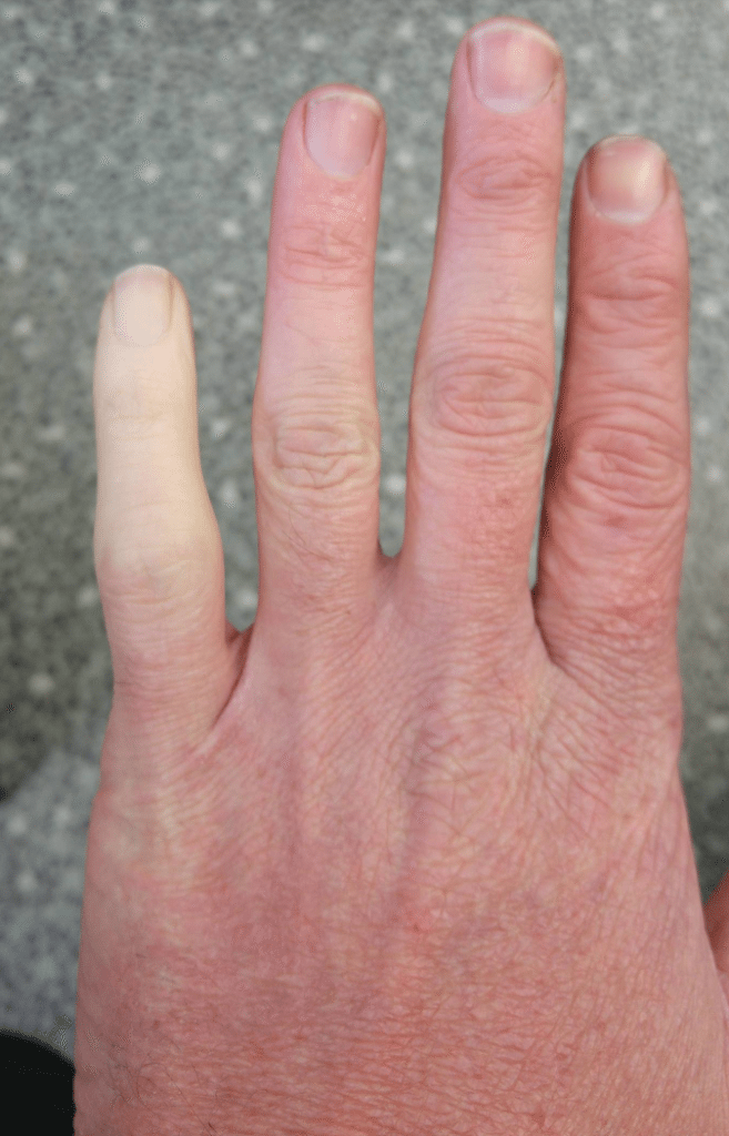 man-s-broken-finger-turns-white-in-the-cold