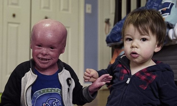 5-Year-Old Boy Born With Harlequin Ichthyosis Needs To Have His Scaly ...