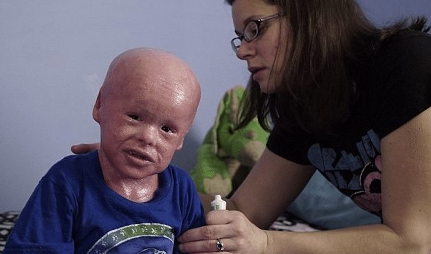 5-Year-Old Boy Born With Harlequin Ichthyosis Needs To Have His Scaly ...