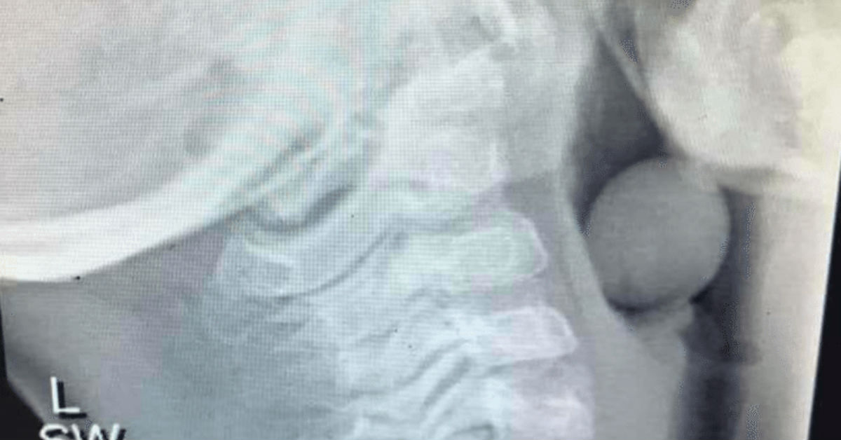 X-Ray Of A Grape In Child’s Throat Is Going Viral