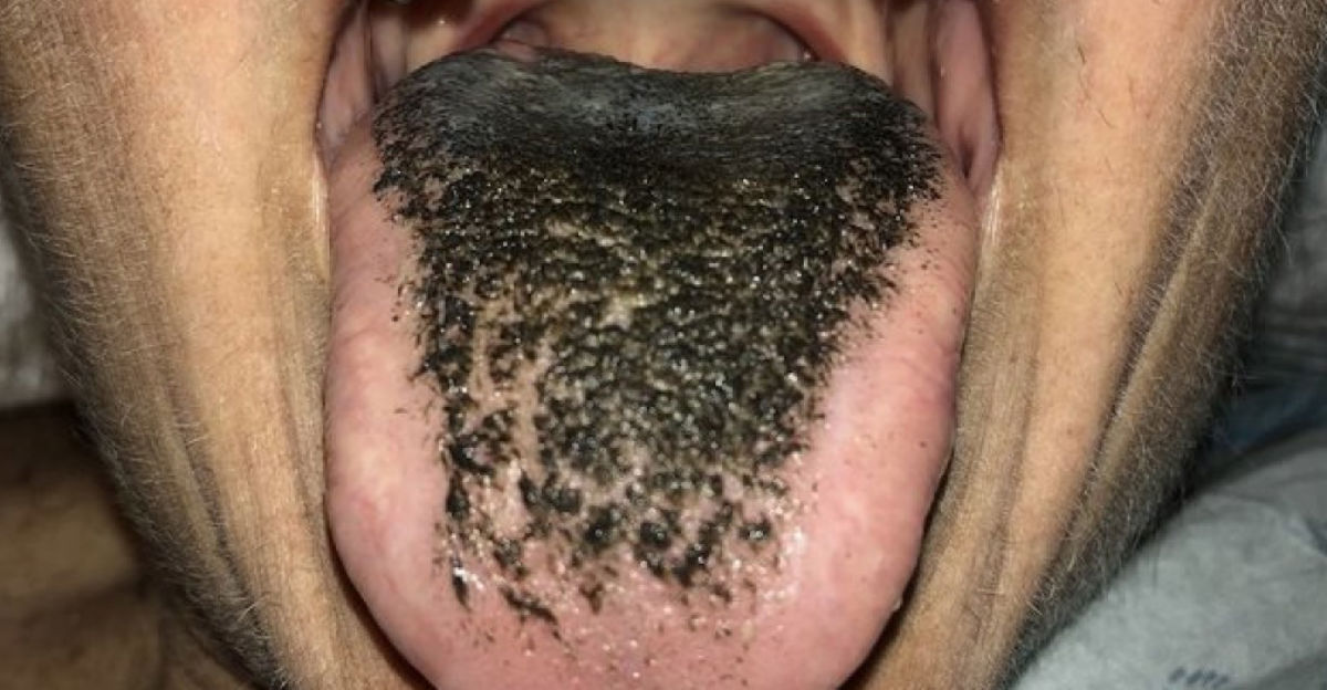 People Are Waking Up With Black Tongues