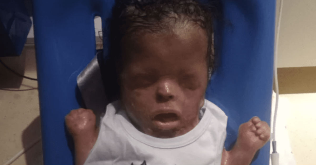 Baby Born Without Skin Finally Goes Home After 11 Months In The Hospital