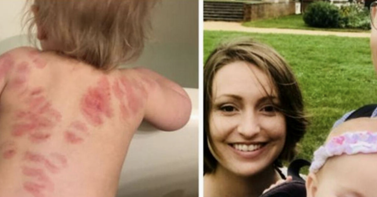 Mom Finds 25 Bite Marks On Baby After She Picked Her Up From Daycare