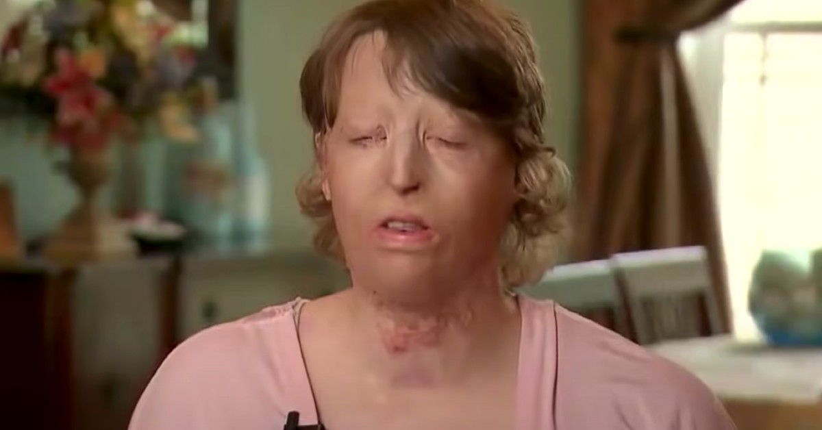 Wife Accidentally Burned By Husband Claims He Divorced Her Because