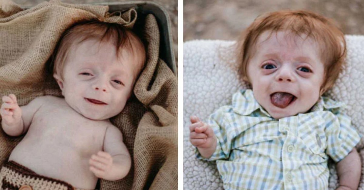 Newborn With Brittle Bone Disease Defies And Proves She’s The Family’s ‘FIGHTER!’