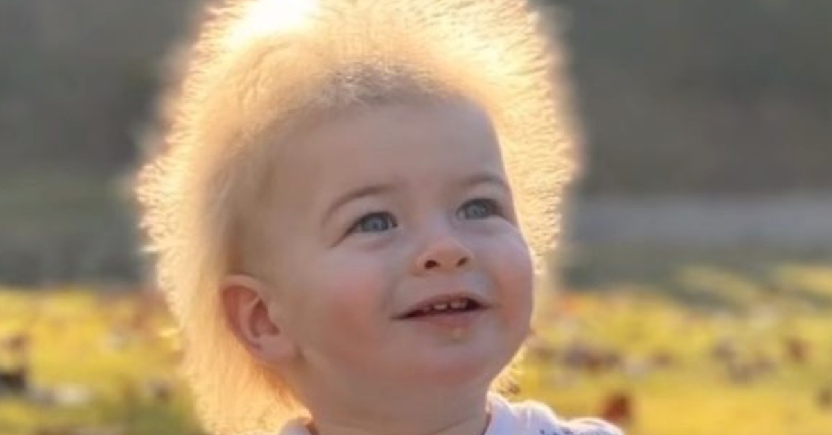 Meet The Baby Diagnosed With Super Rare ‘uncombable Hair Syndrome