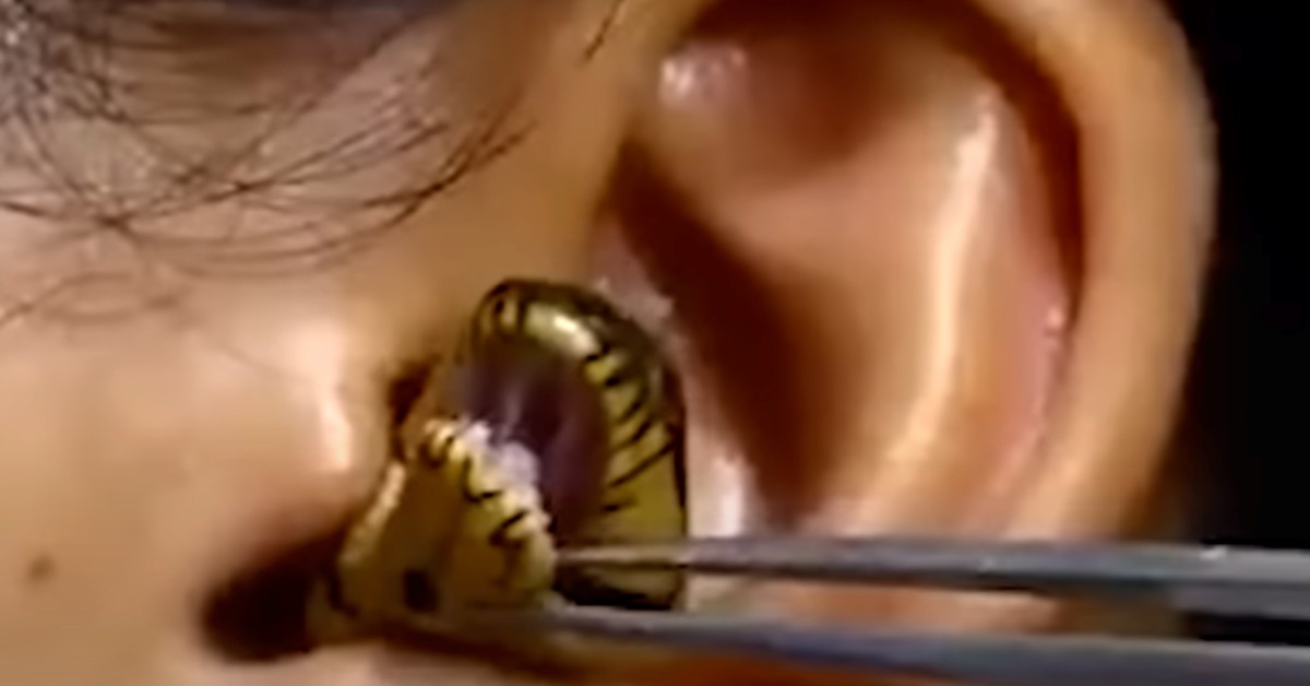 Video Shows Doctor Struggling To Remove A Live Snake From A Woman’s Ear