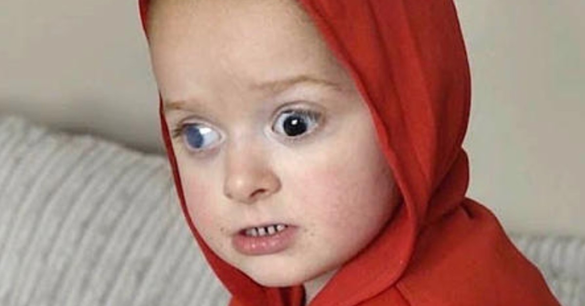 Girl Born With Black Eyes Dubbed &#8216;Vampire Girl,&#8217; Has To Live Very Sad Life